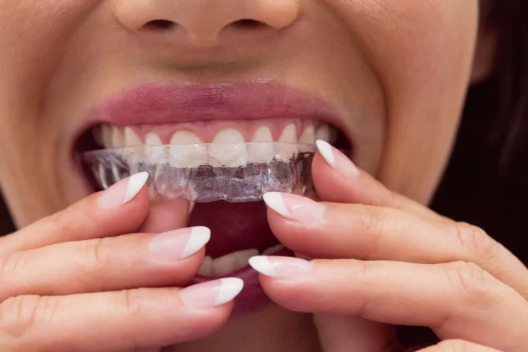 Invisalign Treatment