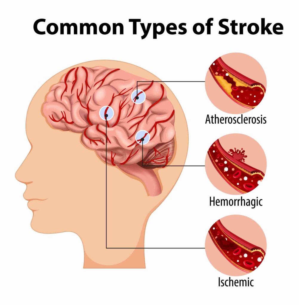 Cerebrovascular Disease