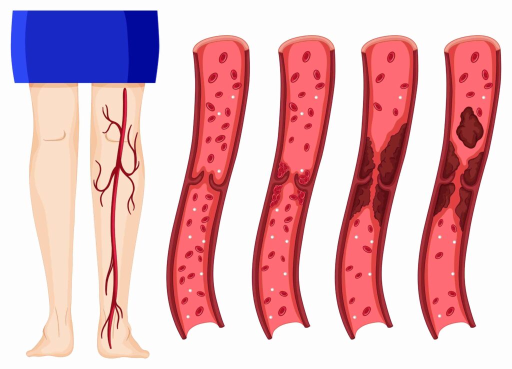 Peripheral Artery Disease